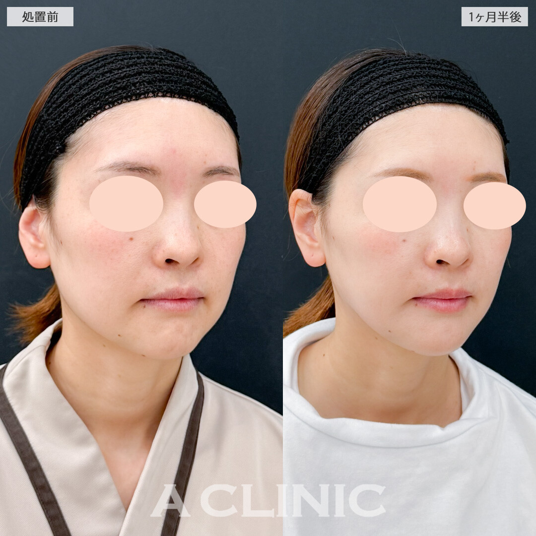 1day小顔脂肪吸引とほうれい線へのヒアルロン酸注射(シワ)で一気に若々しい印象に！処置前と1ヶ月半後の症例です(30代女性)