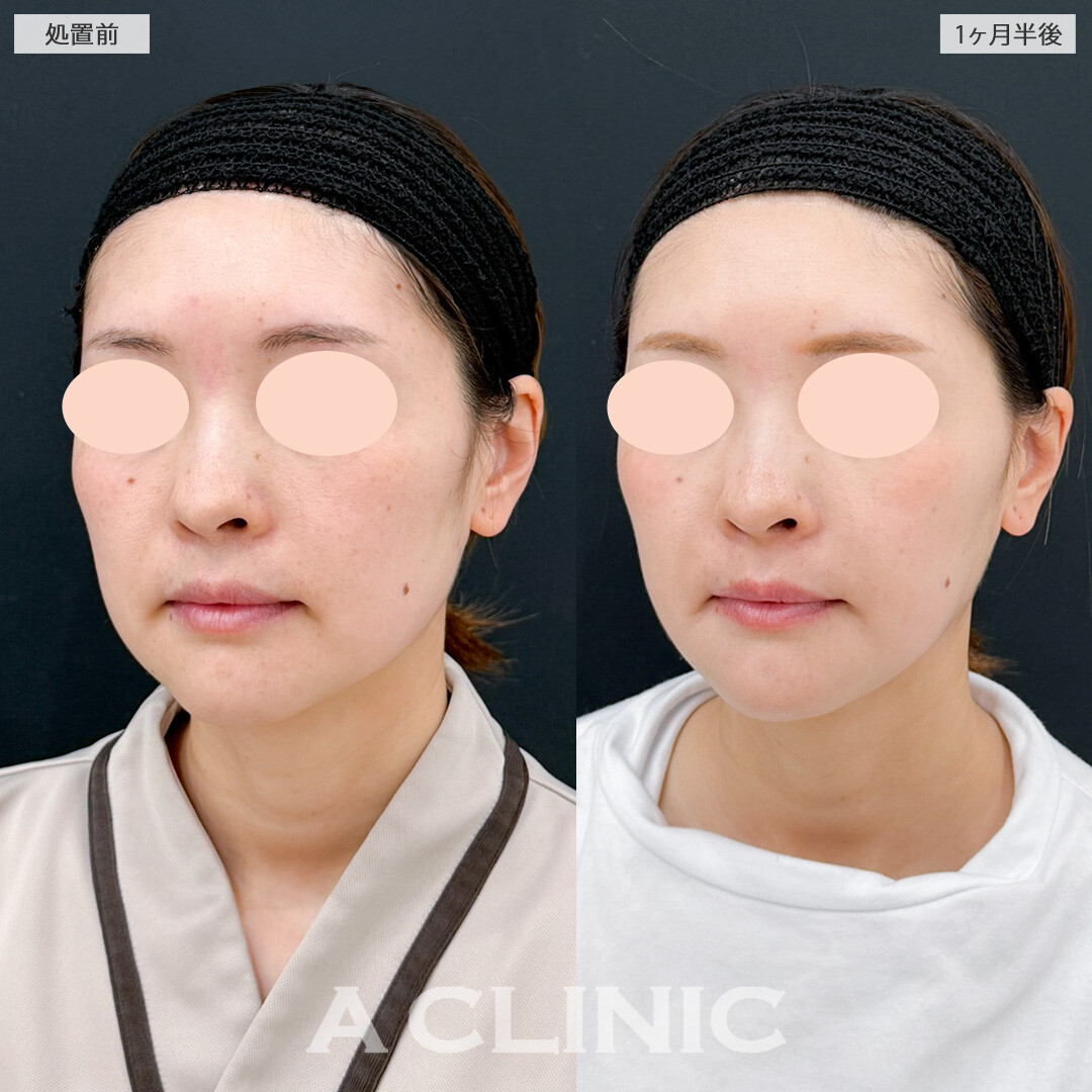 1day小顔脂肪吸引とほうれい線へのヒアルロン酸注射(シワ)で一気に若々しい印象に！処置前と1ヶ月半後の症例です(30代女性)