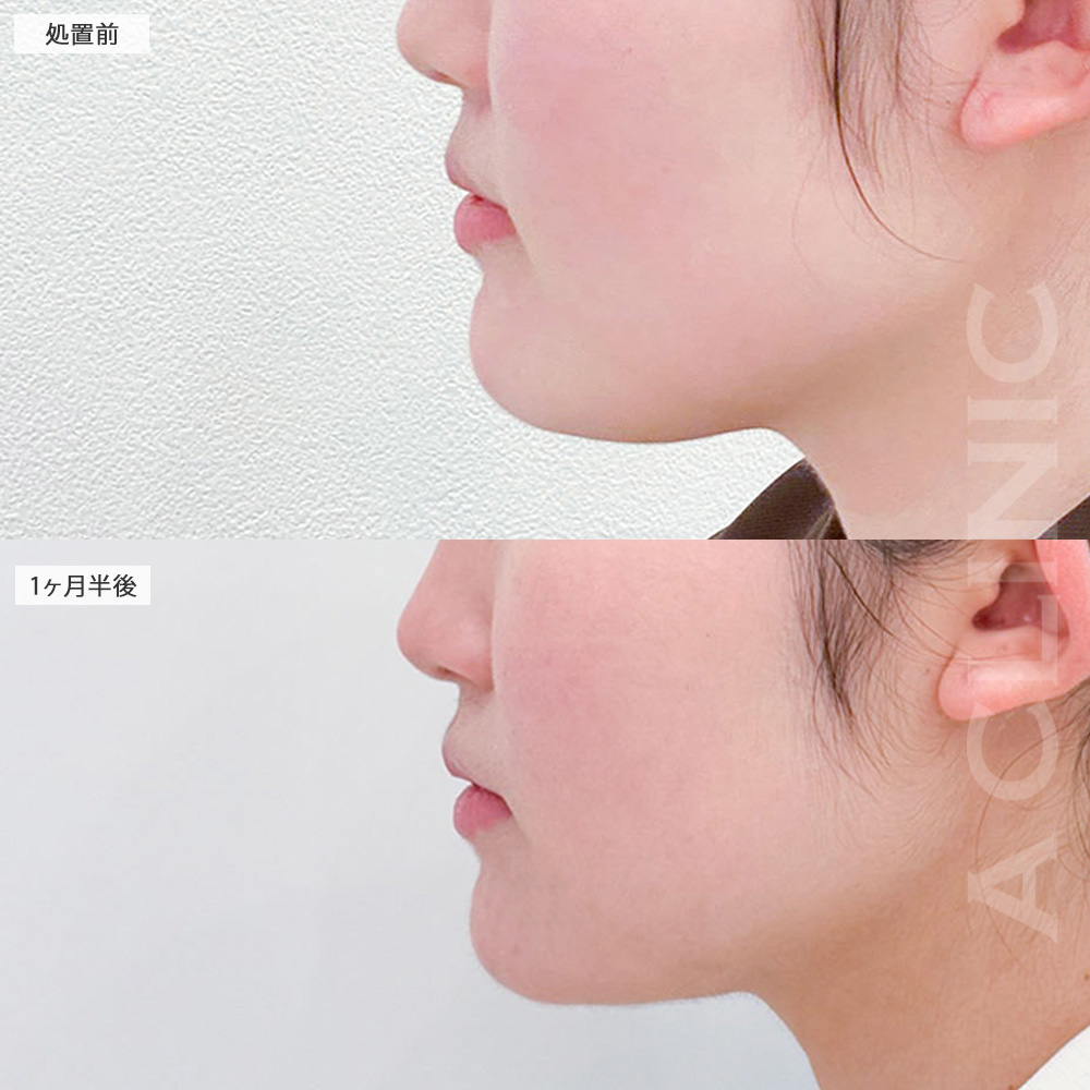 1day小顔脂肪吸引ならあご下のもたつきもここまでスッキリ！処置前から3ヶ月後の症例です(20代女性)