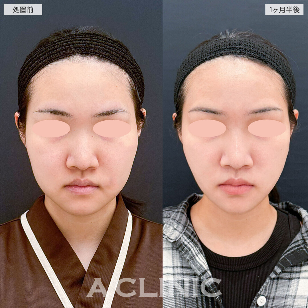 1day小顔脂肪吸引とナゾラビアルファット除去術で輪郭の形が変わりました！こちら処置前と1ヶ月半後の症例です(20代女性)