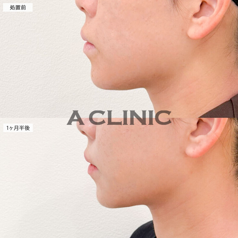 1day小顔脂肪吸引であご下スッキリの綺麗な横顔に！処置前から3ヶ月半後の症例です(20代女性)