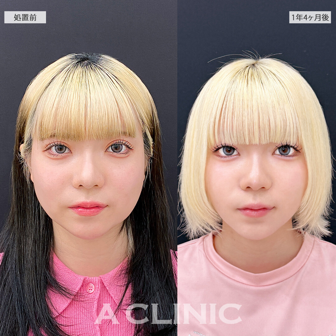 脂肪吸引は一度受けたら半永久的に小顔効果が続きます！1day小顔脂肪吸引の処置前と1年4ヶ月後の症例です(20代女性)