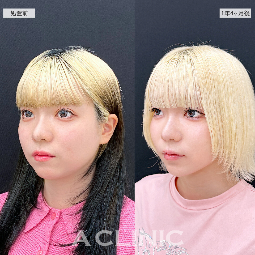 脂肪吸引は一度受けたら半永久的に小顔効果が続きます！1day小顔脂肪吸引の処置前と1年4ヶ月後の症例です(20代女性)