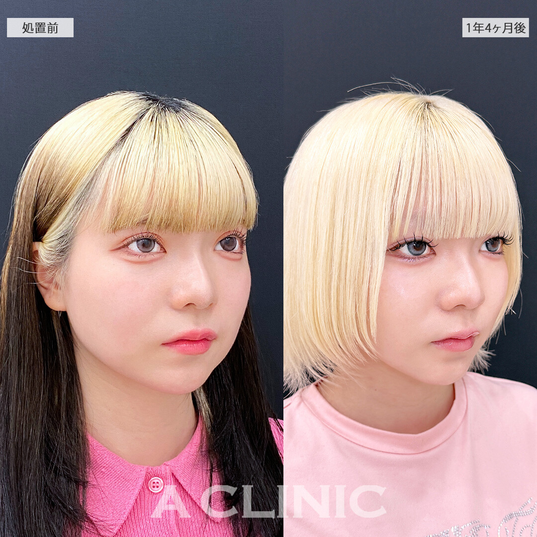 脂肪吸引は一度受けたら半永久的に小顔効果が続きます！1day小顔脂肪吸引の処置前と1年4ヶ月後の症例です(20代女性)