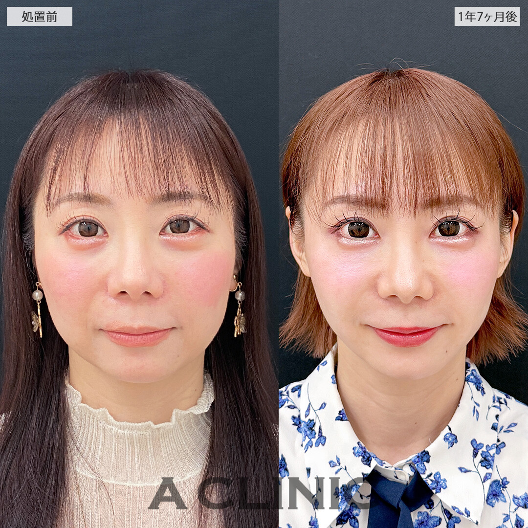 1day小顔脂肪吸引なら時間がたっても小顔をキープ！こちら処置前と1年7ヶ月後の症例です(30代女性)