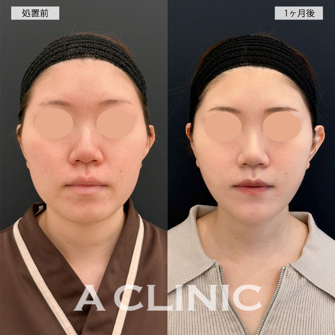 1day小顔脂肪吸引で顔の横幅が狭くなり小顔になれました！こちら処置前と1ヶ月後の症例です(20代女性)