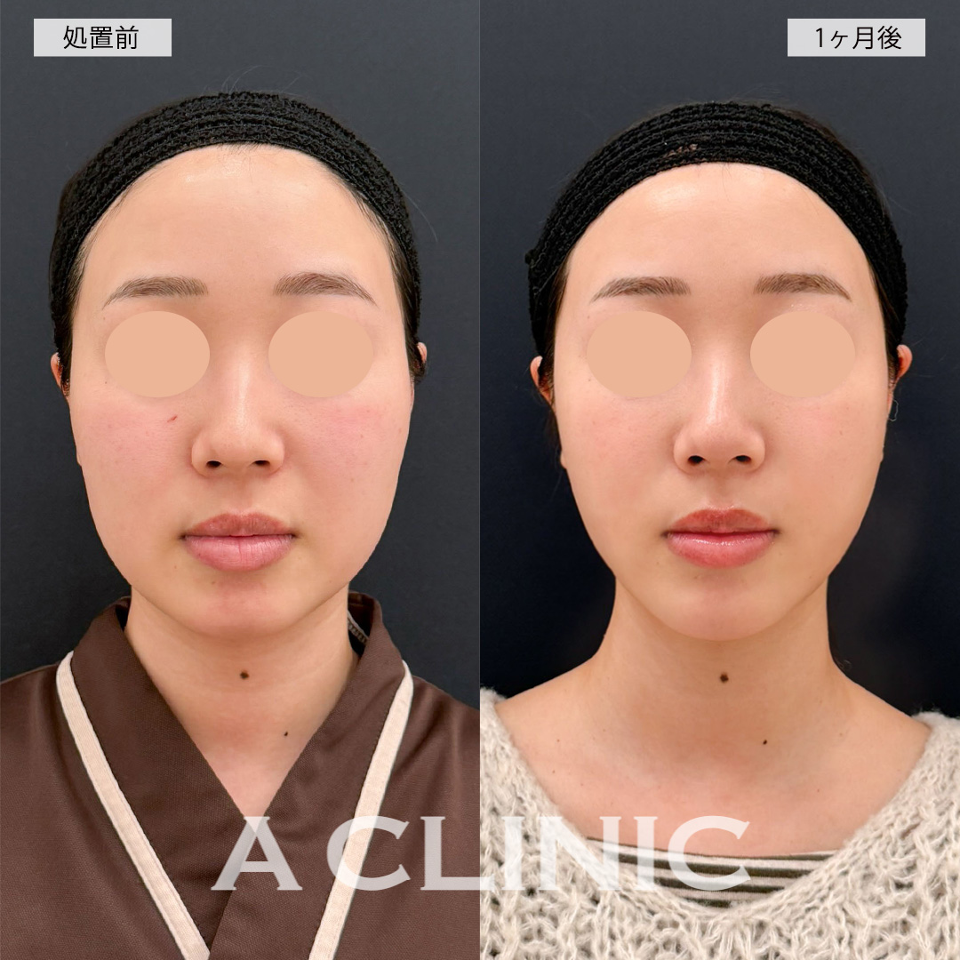 1day小顔脂肪吸引とあごへのヒアルロン酸注入で綺麗なEラインができ写真映えするお顔に！こちら処置前と1ヶ月後の症例です(20代女性)
