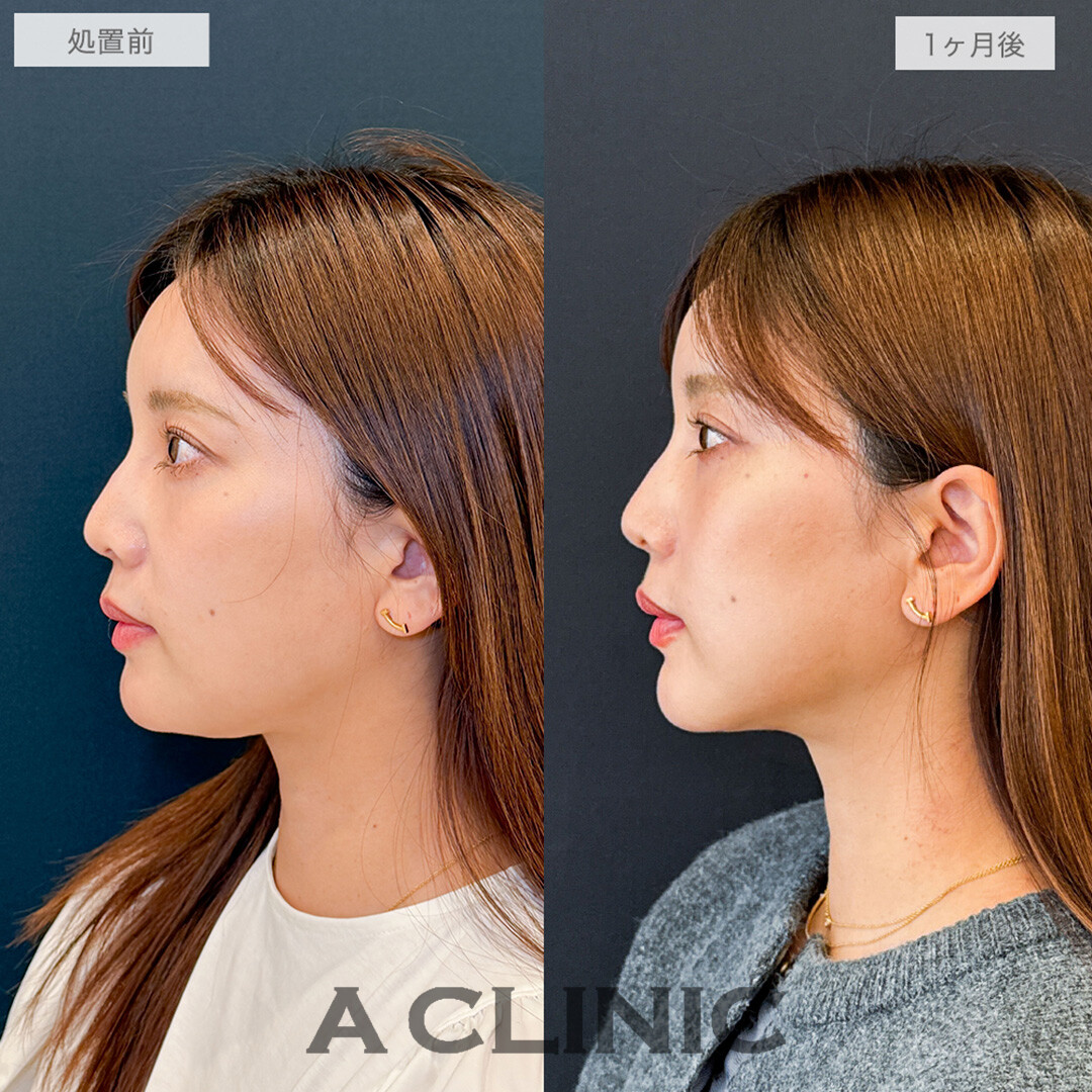 1day小顔脂肪吸引で横顔激変してスッキリした印象に！こちら処置前と1ヶ月後の症例です(30代女性)