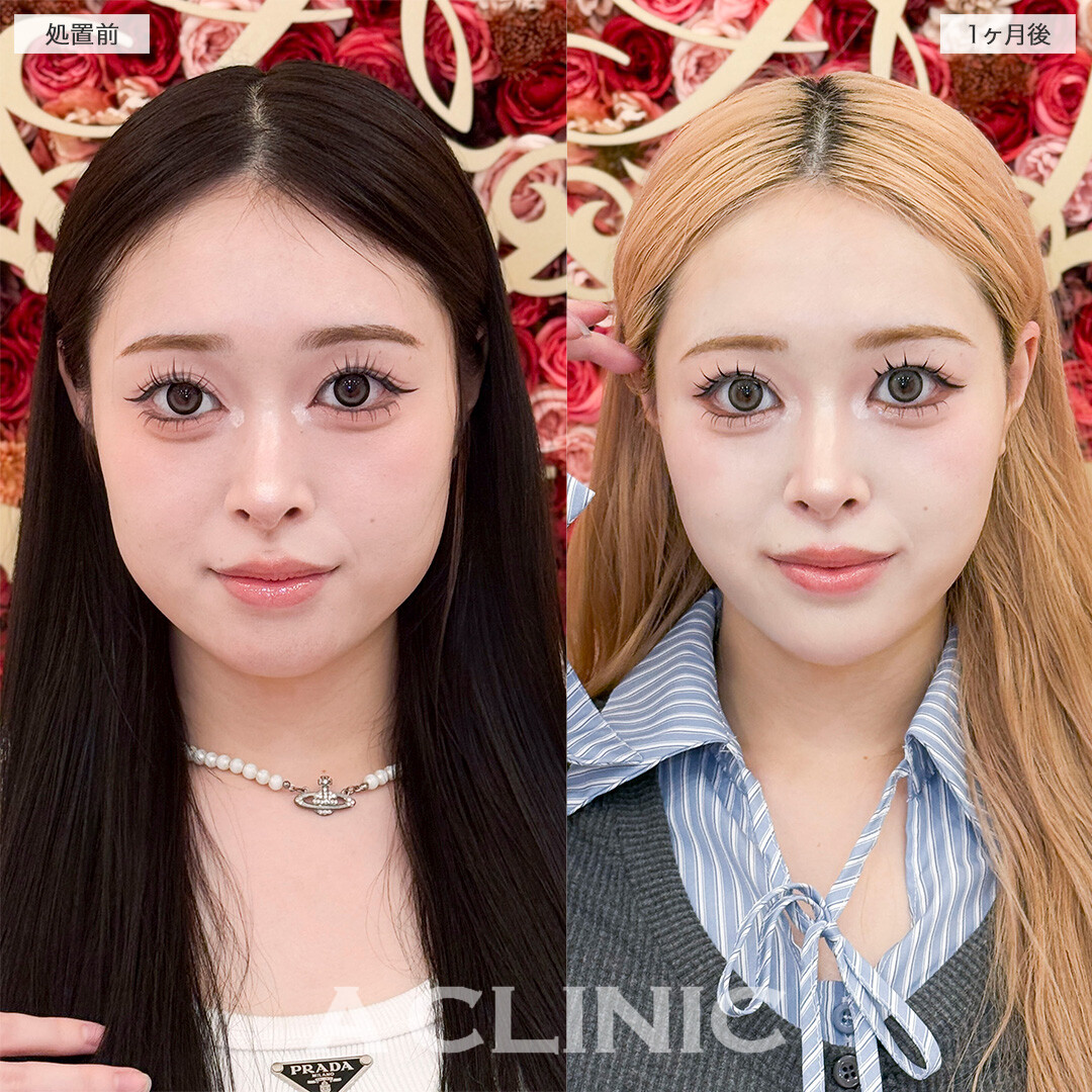 1day小顔脂肪吸引とあごへのヒアルロン酸注入で加工不要の輪郭になりました！処置前と1ヶ月後の症例です(20代女性)