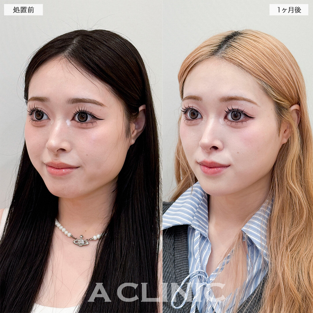 1day小顔脂肪吸引とあごへのヒアルロン酸注入で加工不要の輪郭になりました！処置前と1ヶ月後の症例です(20代女性)