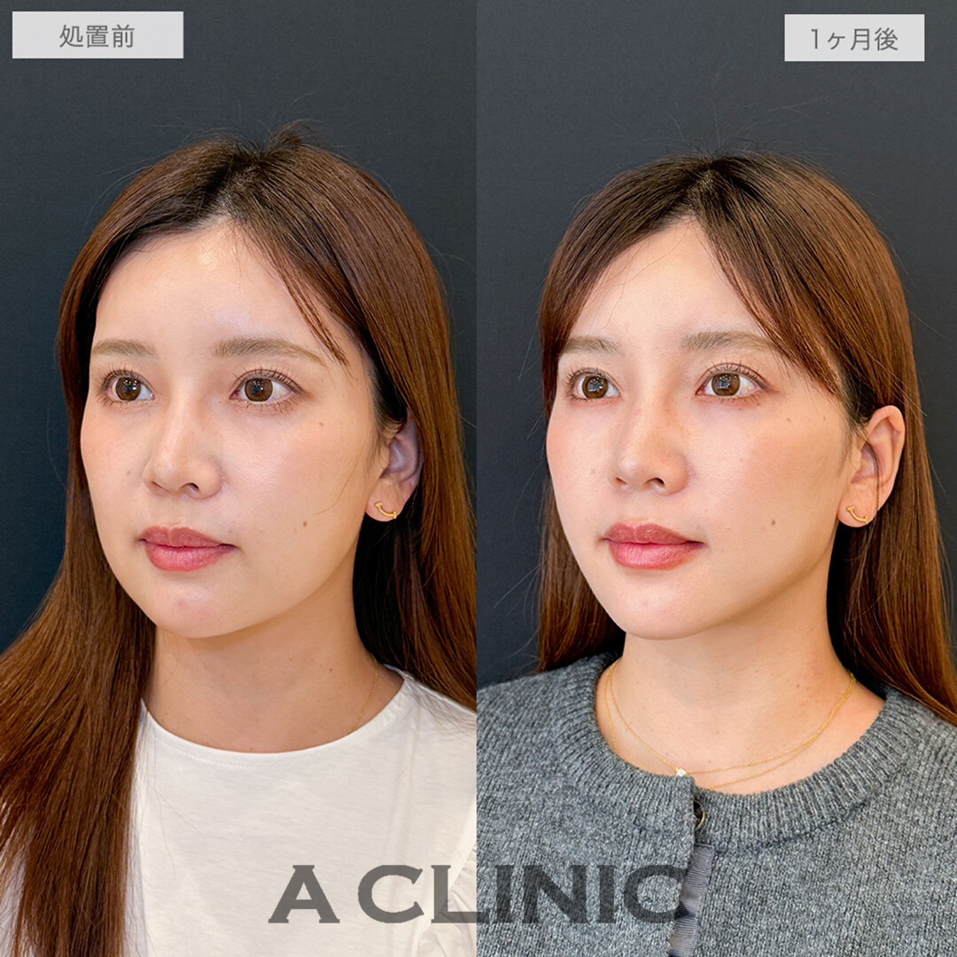 1day小顔脂肪吸引で横顔激変してスッキリした印象に！こちら処置前と1ヶ月後の症例です(30代女性)
