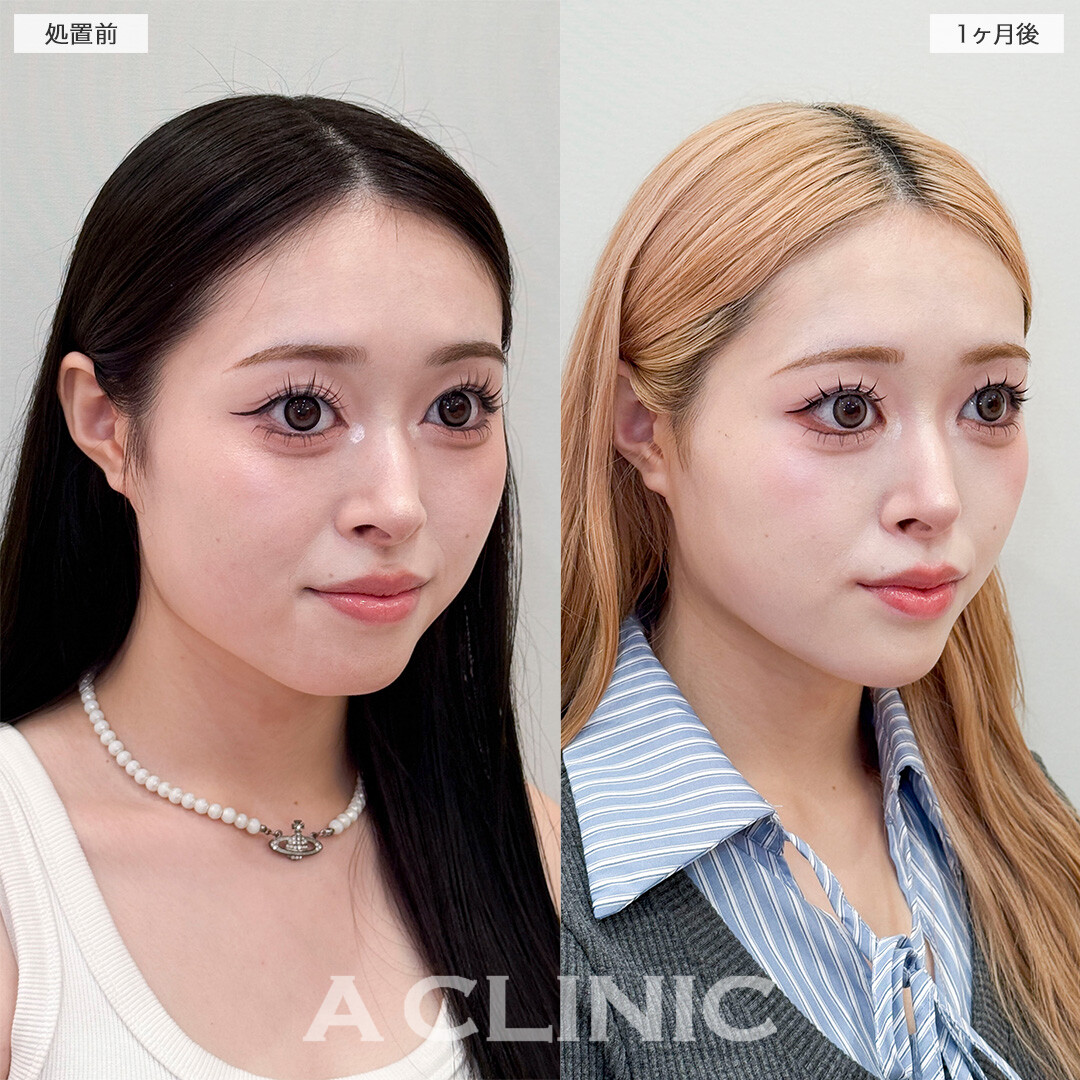 1day小顔脂肪吸引とあごへのヒアルロン酸注入で加工不要の輪郭になりました！処置前と1ヶ月後の症例です(20代女性)