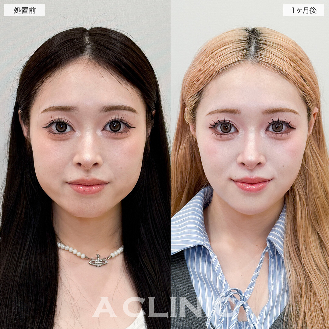 1day小顔脂肪吸引とあごへのヒアルロン酸注入で加工不要の輪郭になりました！処置前と1ヶ月後の症例です(20代女性)