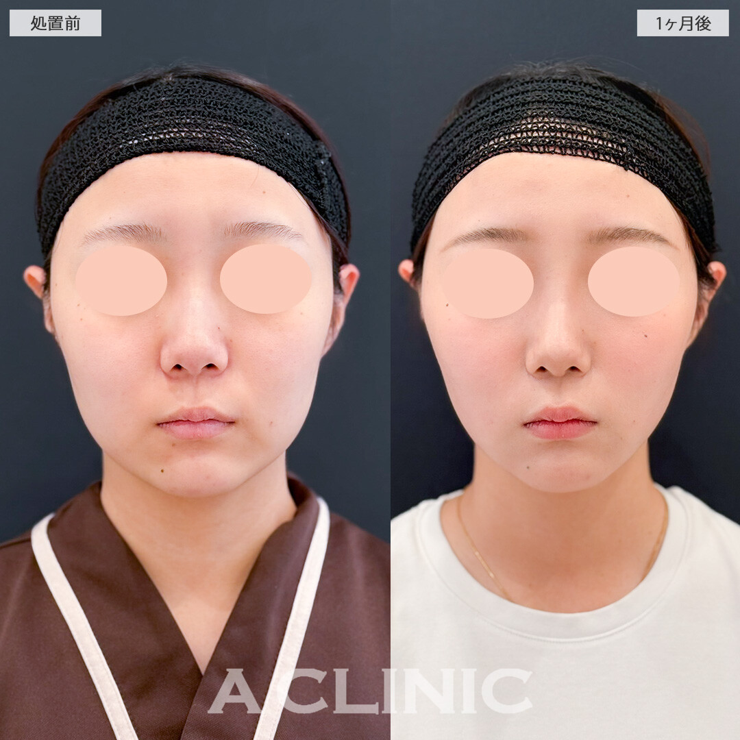 1day小顔脂肪吸引で輪郭を整えると一気に垢抜け顔になります！処置前と1ヶ月後の症例です(20代女性)