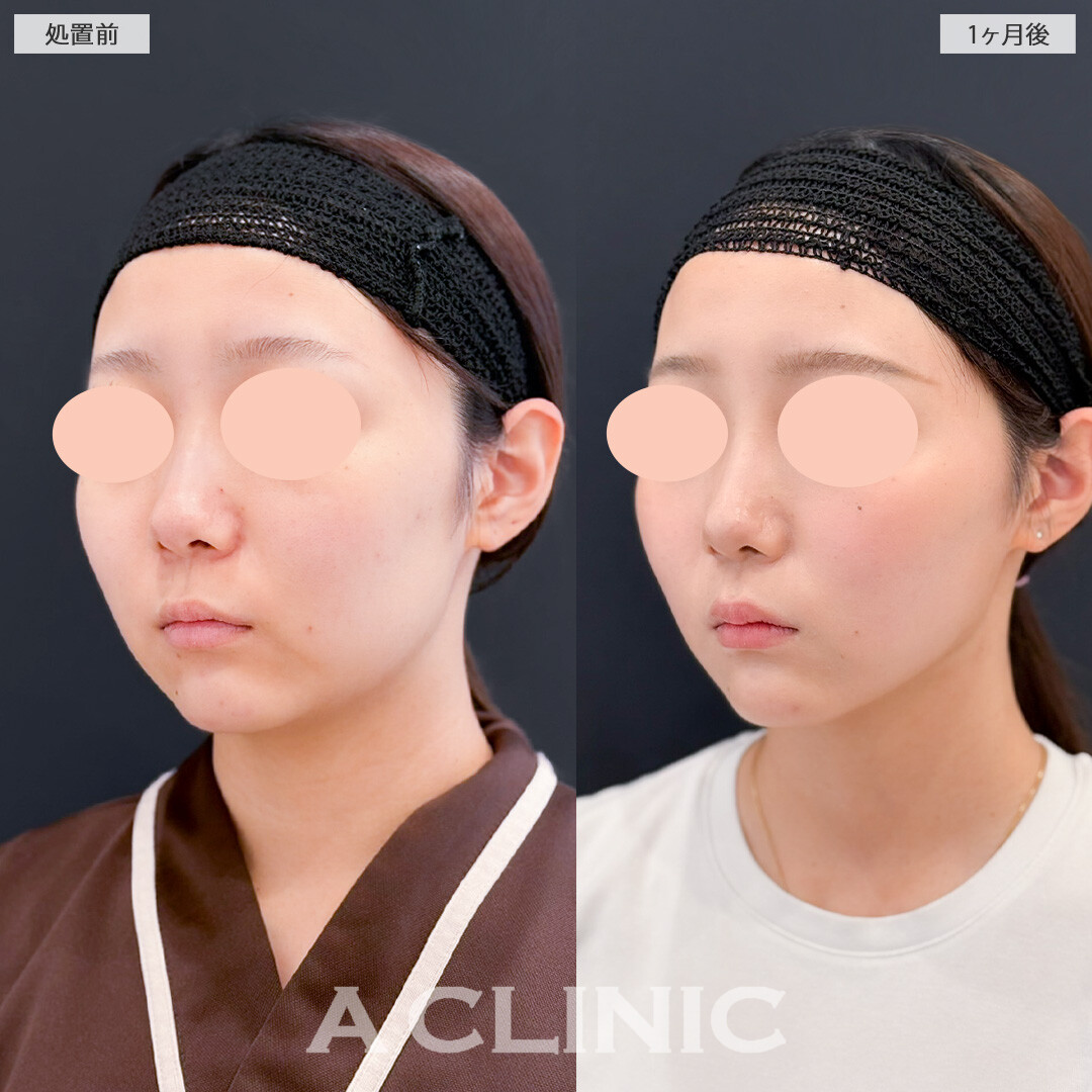 1day小顔脂肪吸引で輪郭を整えると一気に垢抜け顔になります！処置前と1ヶ月後の症例です(20代女性)