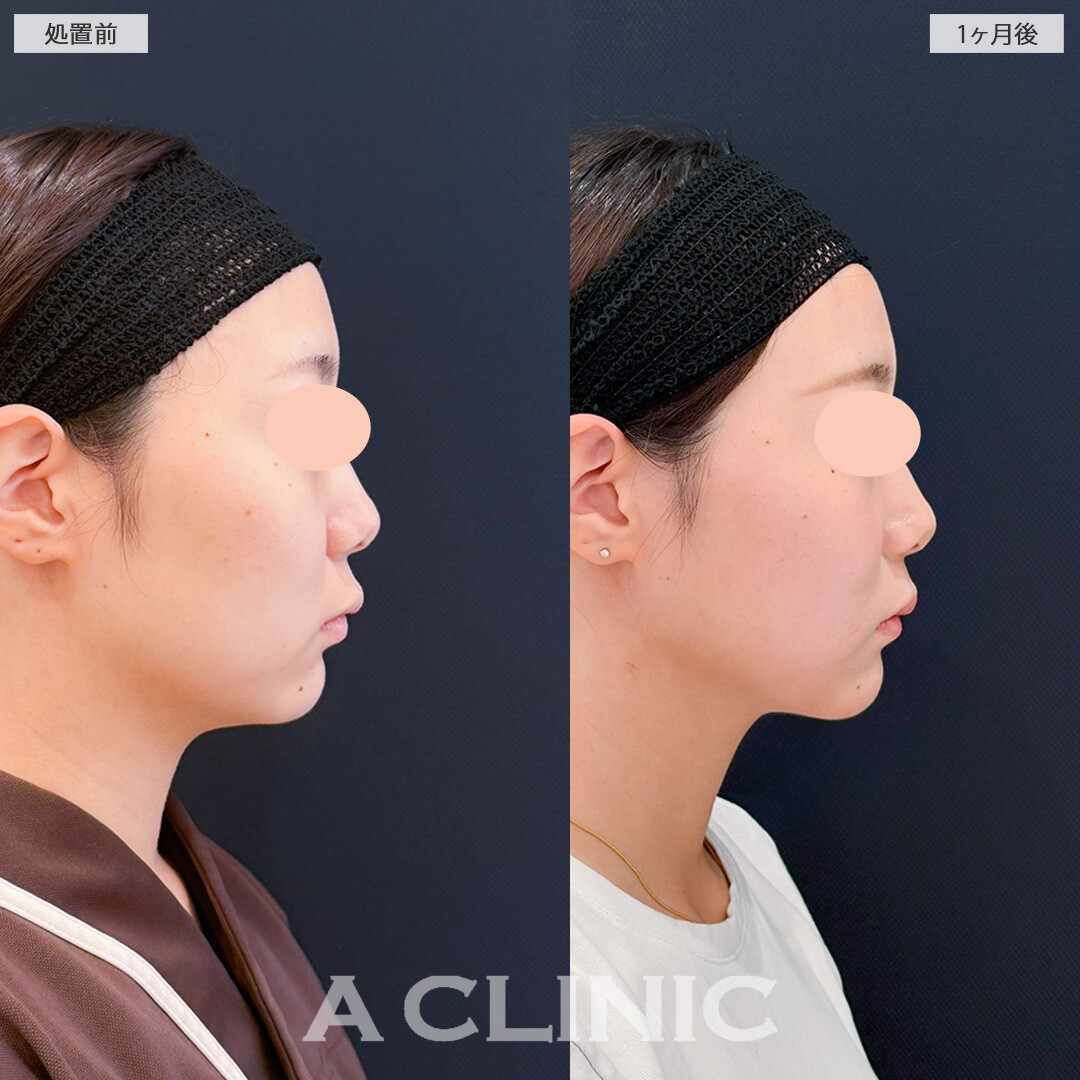 1day小顔脂肪吸引で輪郭を整えると一気に垢抜け顔になります！処置前と1ヶ月後の症例です(20代女性)