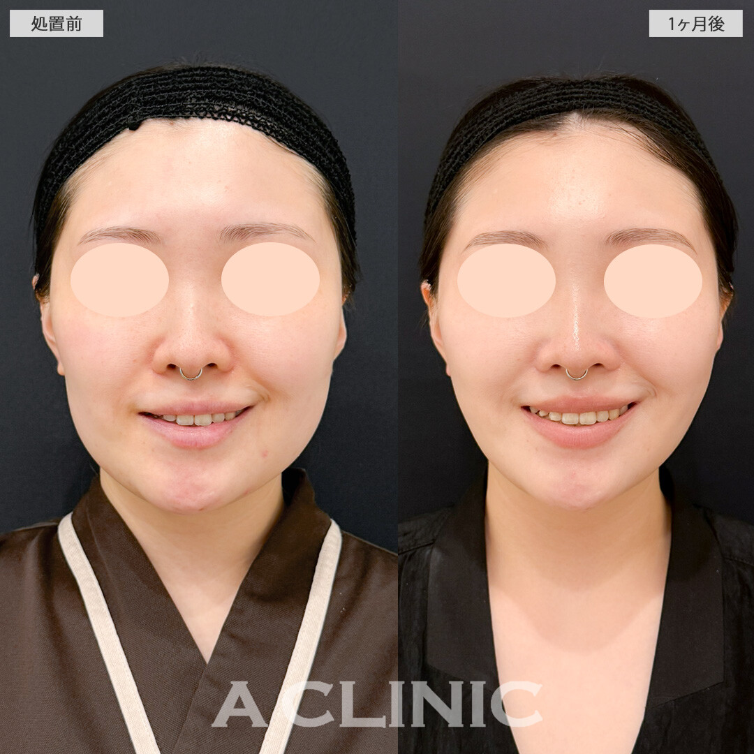1day小顔脂肪吸引とバッカルファット除去術で笑った時の顔の脂肪が目立たなくなりました！処置前と1ヶ月後の症例です(20代女性)