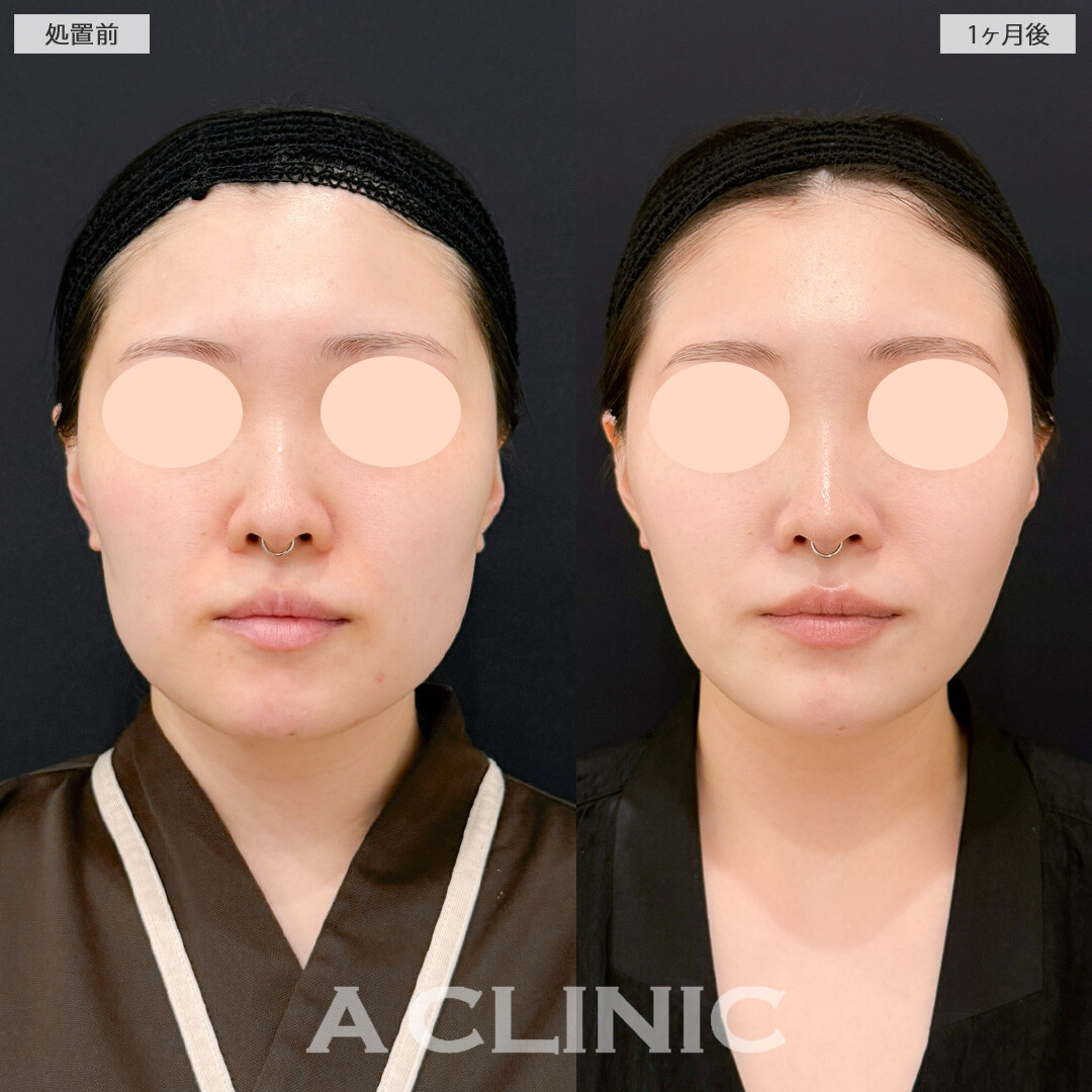 1day小顔脂肪吸引とバッカルファット除去術で笑った時の顔の脂肪が目立たなくなりました！処置前と1ヶ月後の症例です(20代女性)