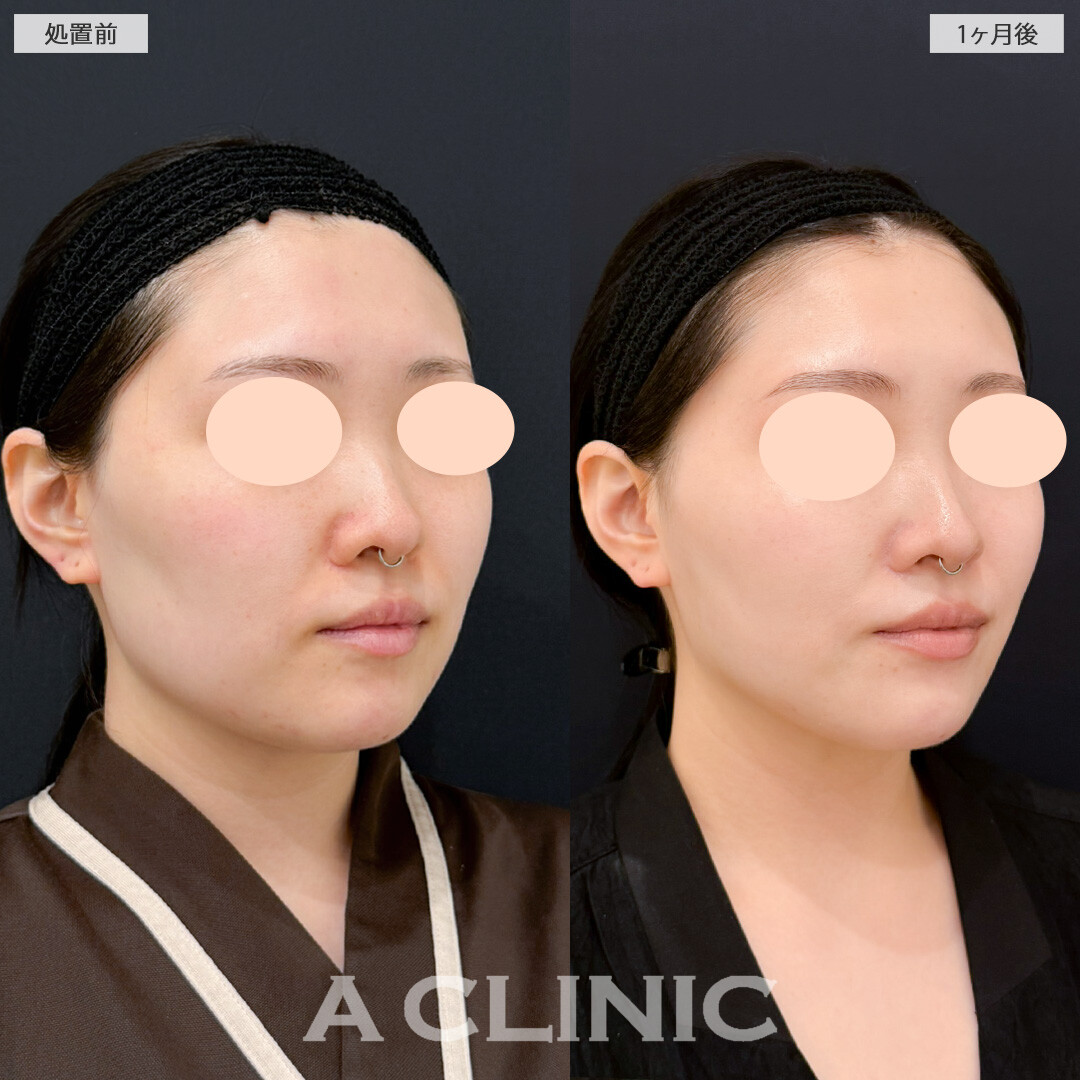1day小顔脂肪吸引とバッカルファット除去術で笑った時の顔の脂肪が目立たなくなりました！処置前と1ヶ月後の症例です(20代女性)