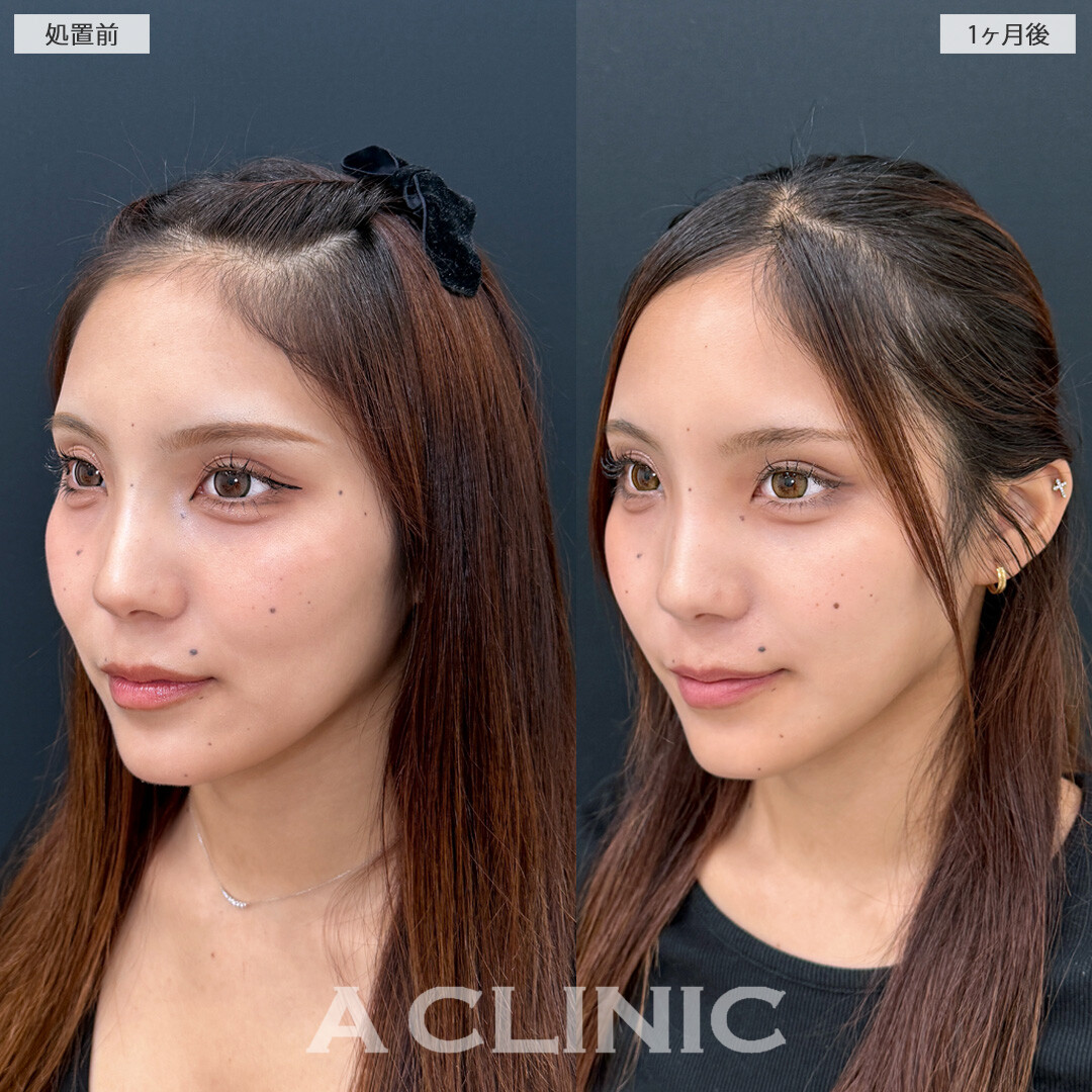 脂肪吸引なら痩せても残るしぶといお顔の脂肪に直接アプローチ！こちら1day小顔脂肪吸引の処置前と1ヵ月後の症例です(10代女性)