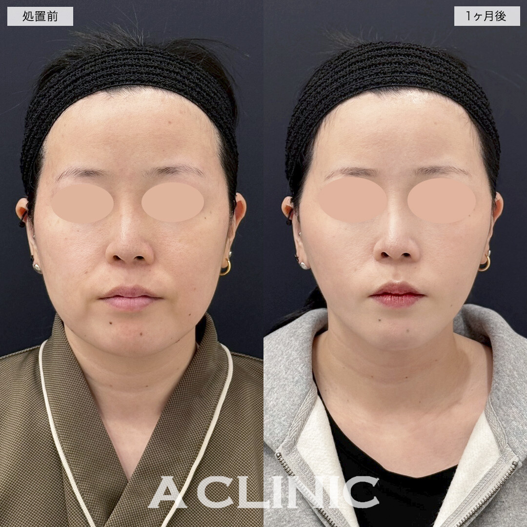 1day小顔脂肪吸引と小顔エラボトックスで四角い輪郭が丸くなりました！処置前と1ヶ月後の症例です(30代女性)