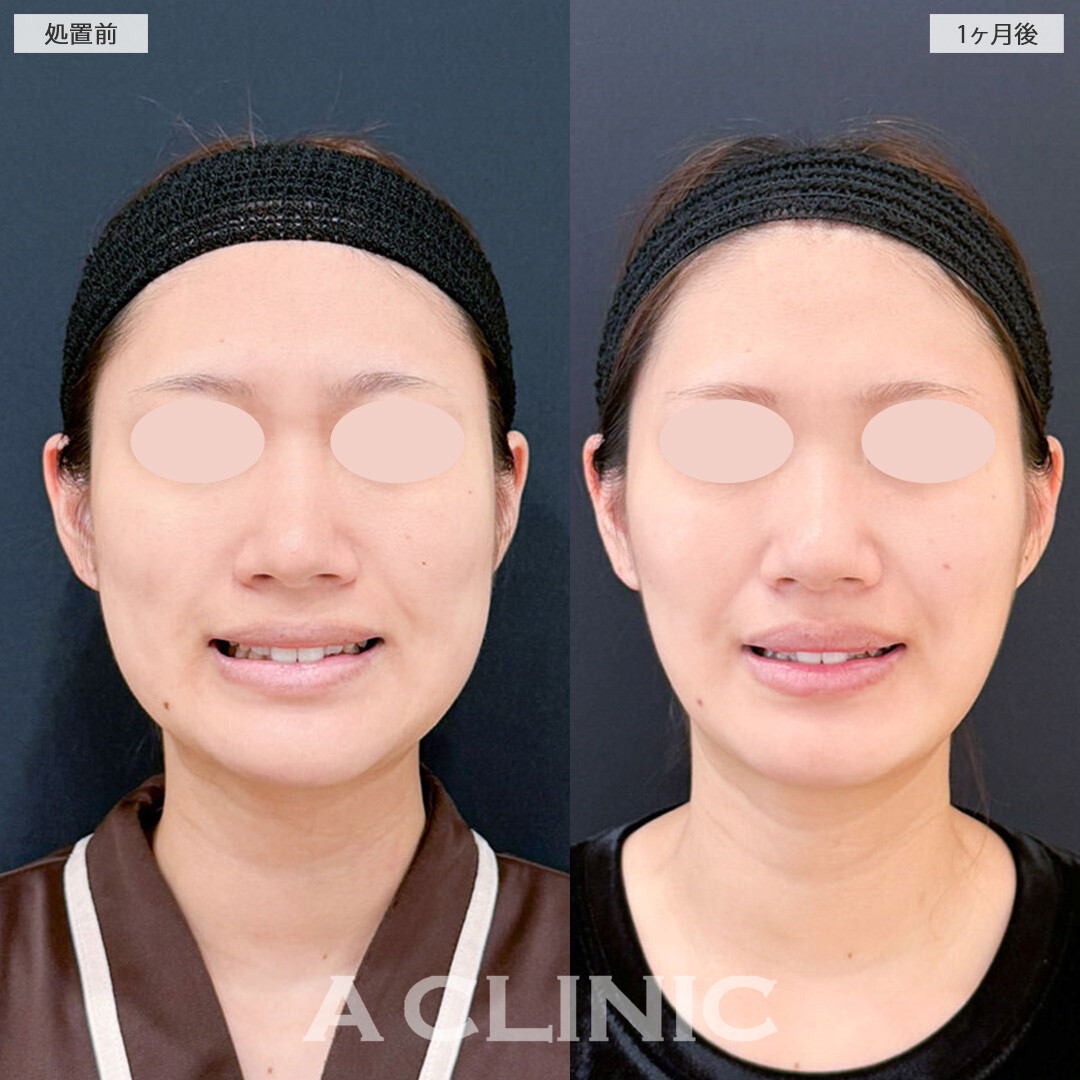 1day小顔脂肪吸引とバッカルファット除去術と小顔エラボトックスでお顔の余白が減り小顔になりました！こちら処置前と1ヶ月後の症例です(20代女性)