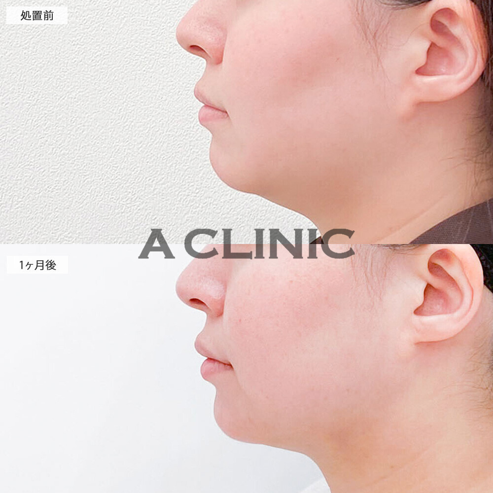 1day小顔脂肪吸引で二重アゴにならないスッキリ横顔に！こちら処置前から2ヶ月後の症例です(30代女性)