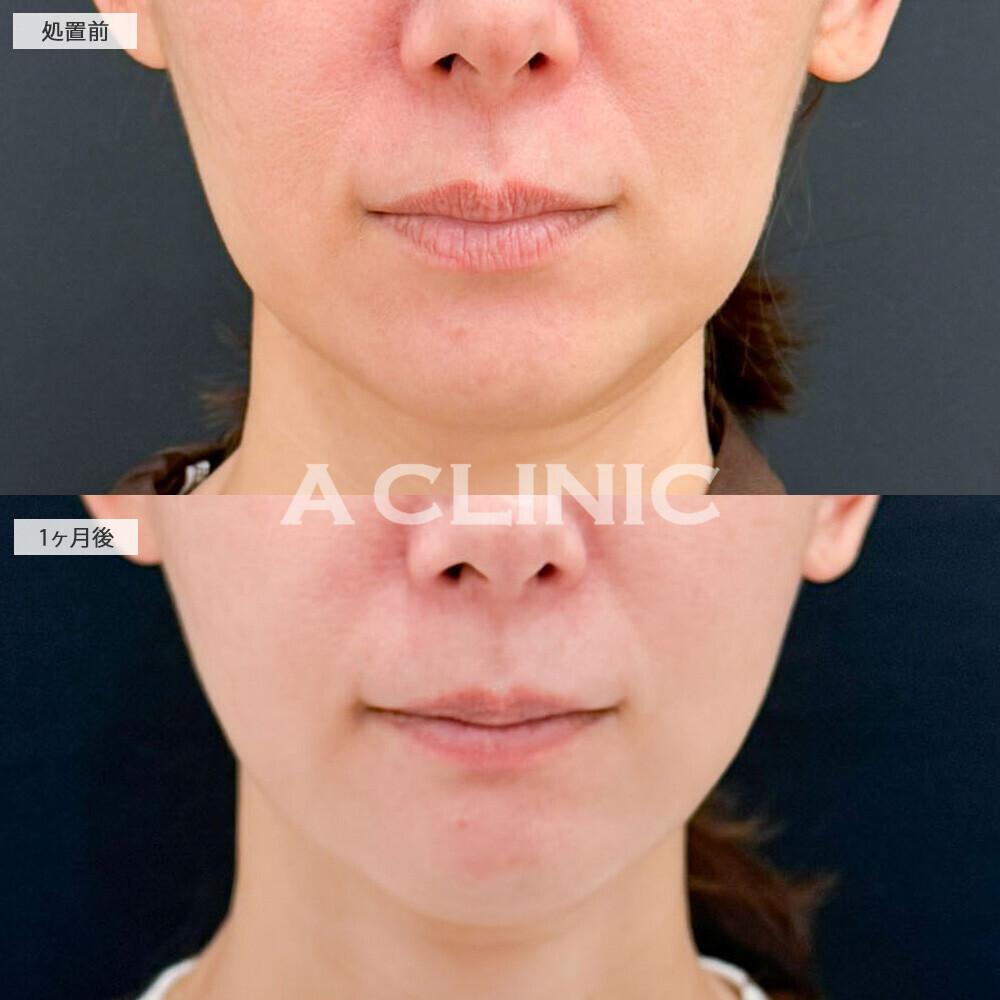 1day小顔脂肪吸引ならたるみ改善と脂肪減少で若返り！処置前から3ヶ月後の症例です(40代女性)