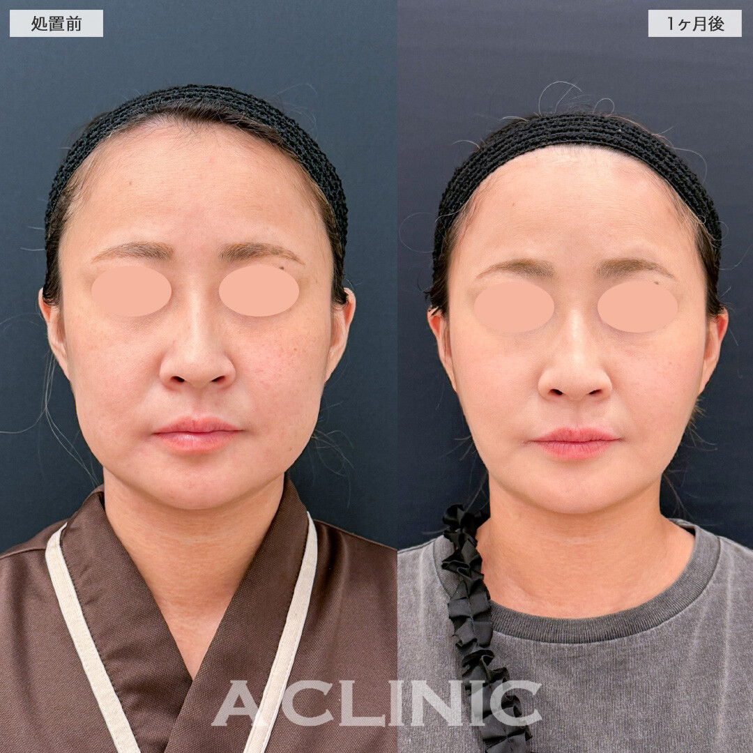 1day小顔脂肪吸引で口横のポニョをスッキリ解消！こちら処置前と1ヶ月後の症例です(30代女性)