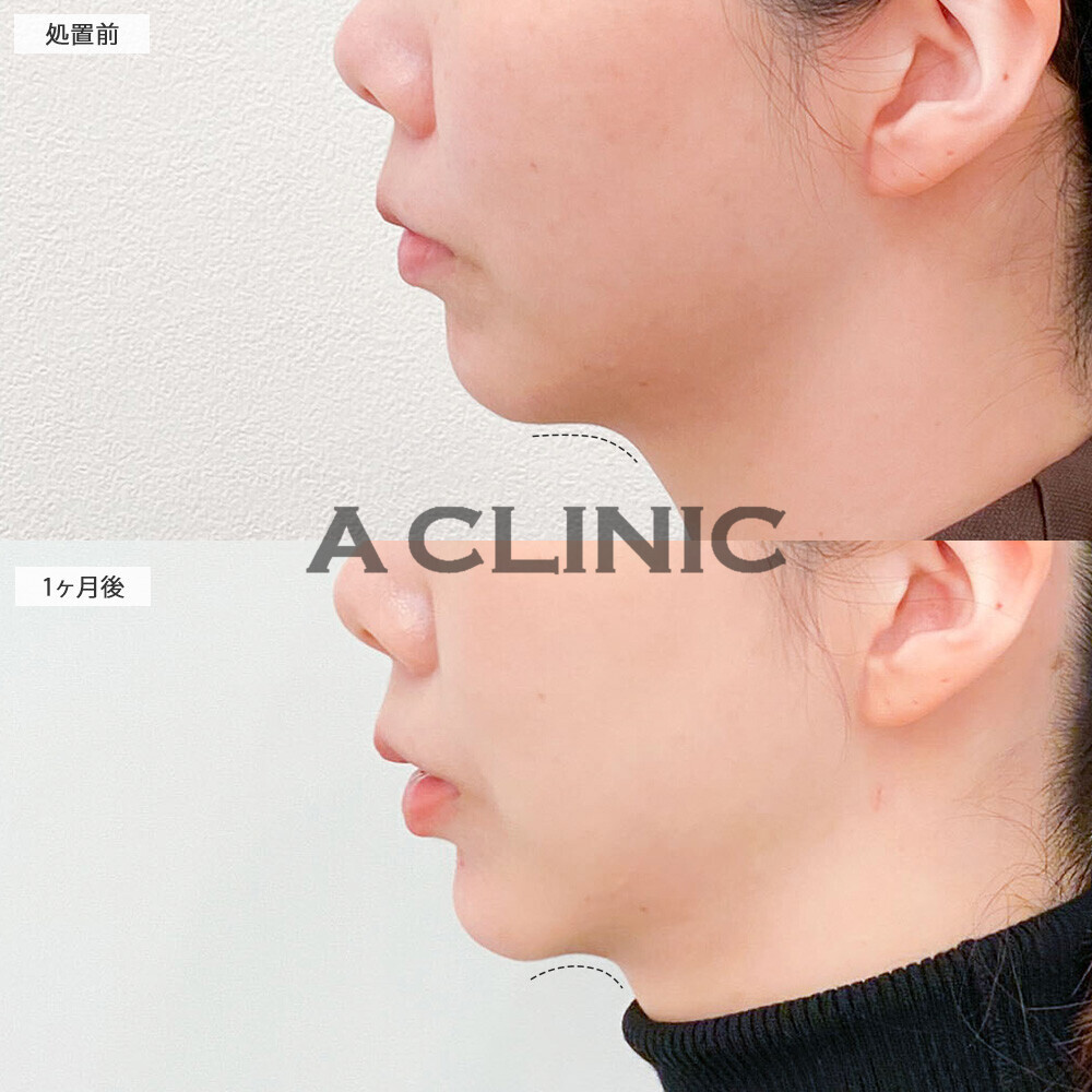 1day小顔脂肪吸引ならダイエットしても残りやすいあご下の脂肪もスッキリ！処置前から2ヶ月後の症例です(20代女性)