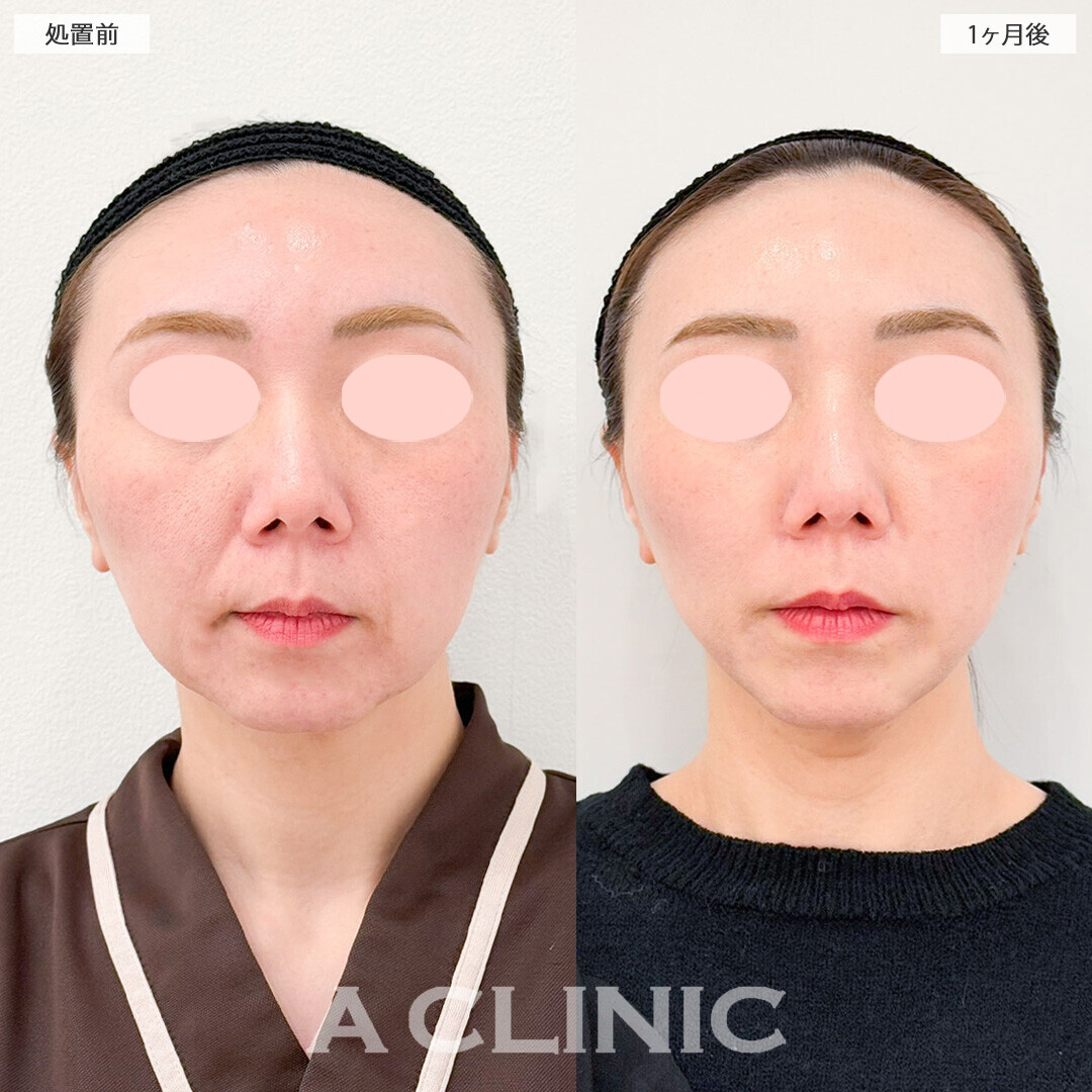1day小顔脂肪吸引で一回りスッキリした理想のVフェイスに！処置前から2ヶ月半後の症例です(30代女性)