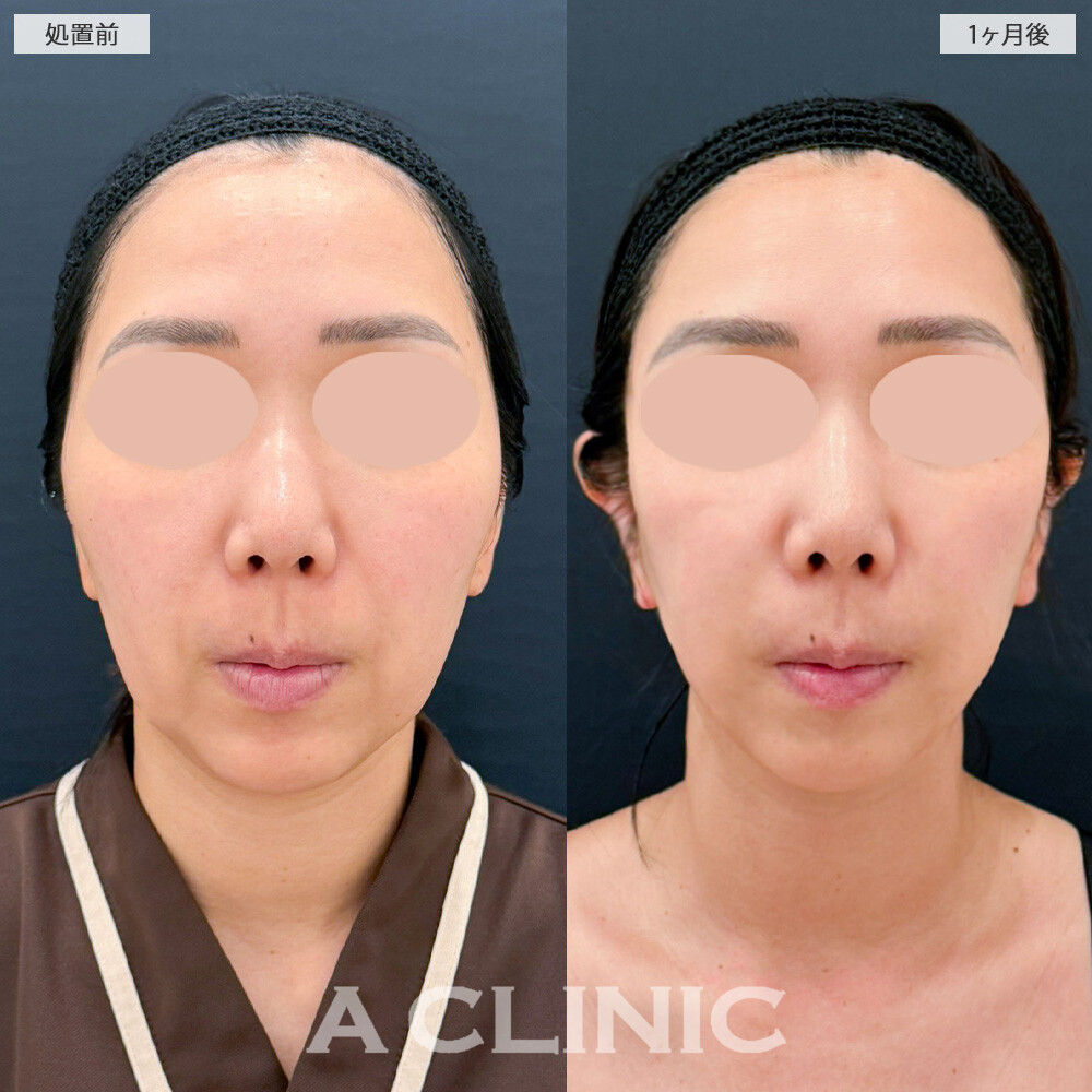 1day小顔脂肪吸引とナゾラビアルファット除去術で見違える程輪郭が変化しました！こちら処置前から2ヶ月半後の症例です(30代女性)