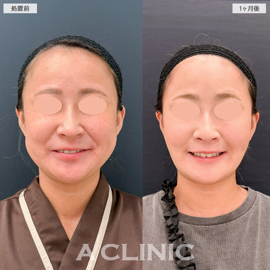 1day小顔脂肪吸引で口横のポニョをスッキリ解消！こちら処置前と1ヶ月後の症例です(30代女性)