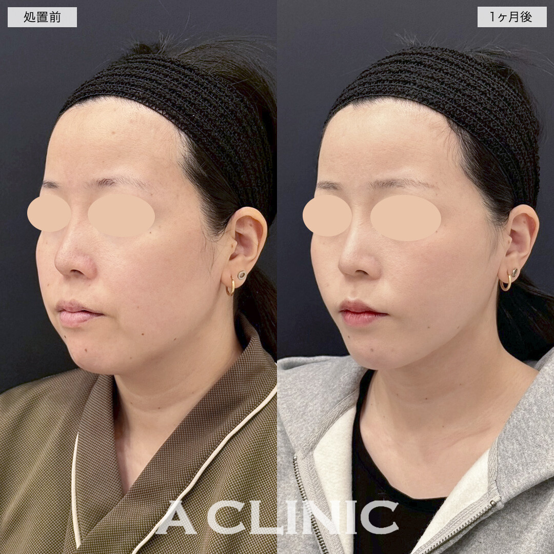 1day小顔脂肪吸引と小顔エラボトックスで四角い輪郭が丸くなりました！処置前と1ヶ月後の症例です(30代女性)