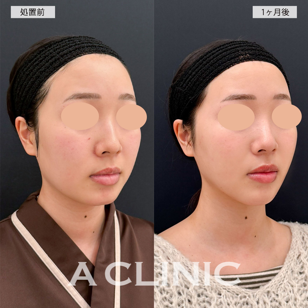 1day小顔脂肪吸引とあごへのヒアルロン酸注入で綺麗なEラインができ写真映えするお顔に！こちら処置前と1ヶ月後の症例です(20代女性)