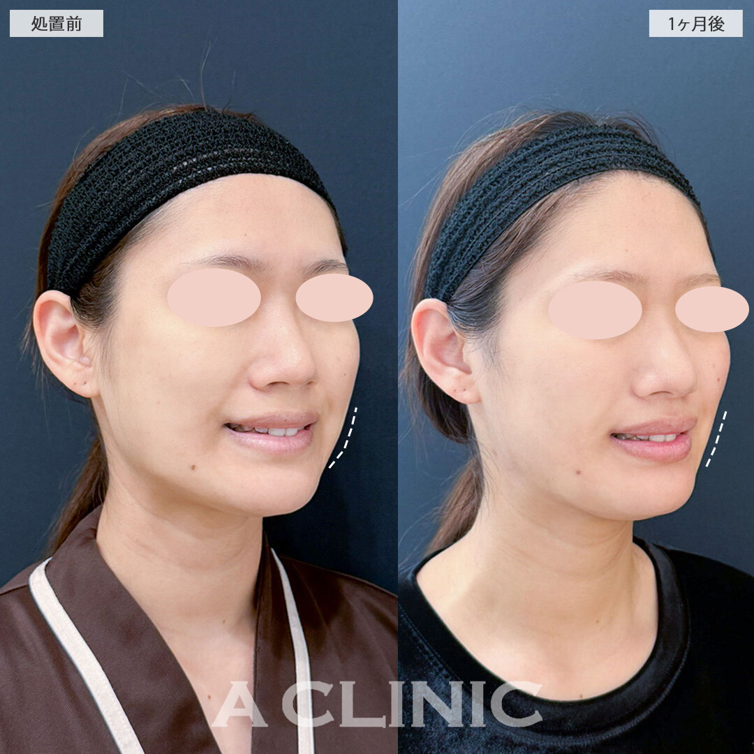 1day小顔脂肪吸引とバッカルファット除去術と小顔エラボトックスでお顔の余白が減り小顔になりました！こちら処置前と1ヶ月後の症例です(20代女性)