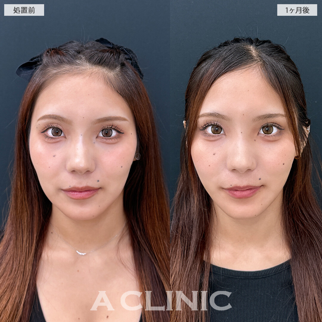 脂肪吸引なら痩せても残るしぶといお顔の脂肪に直接アプローチ！こちら1day小顔脂肪吸引の処置前と1ヵ月後の症例です(10代女性)