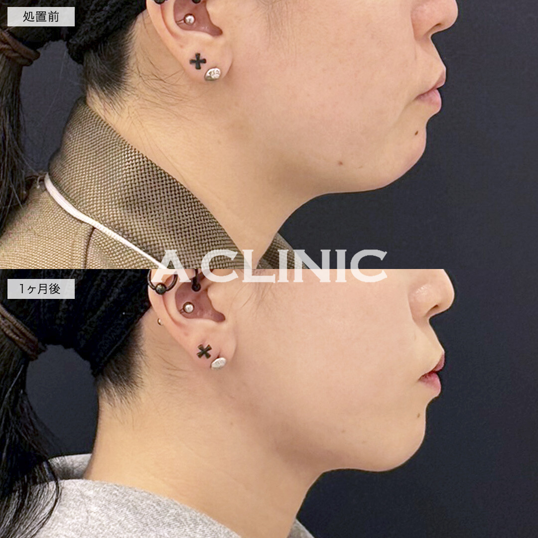 1day小顔脂肪吸引と小顔エラボトックスで四角い輪郭が丸くなりました！処置前と1ヶ月後の症例です(30代女性)