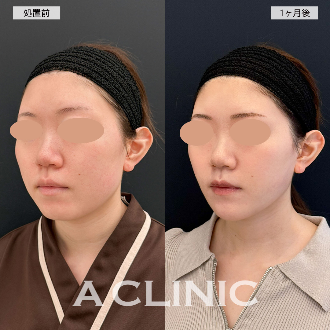 1day小顔脂肪吸引で顔の横幅が狭くなり小顔になれました！こちら処置前と1ヶ月後の症例です(20代女性)