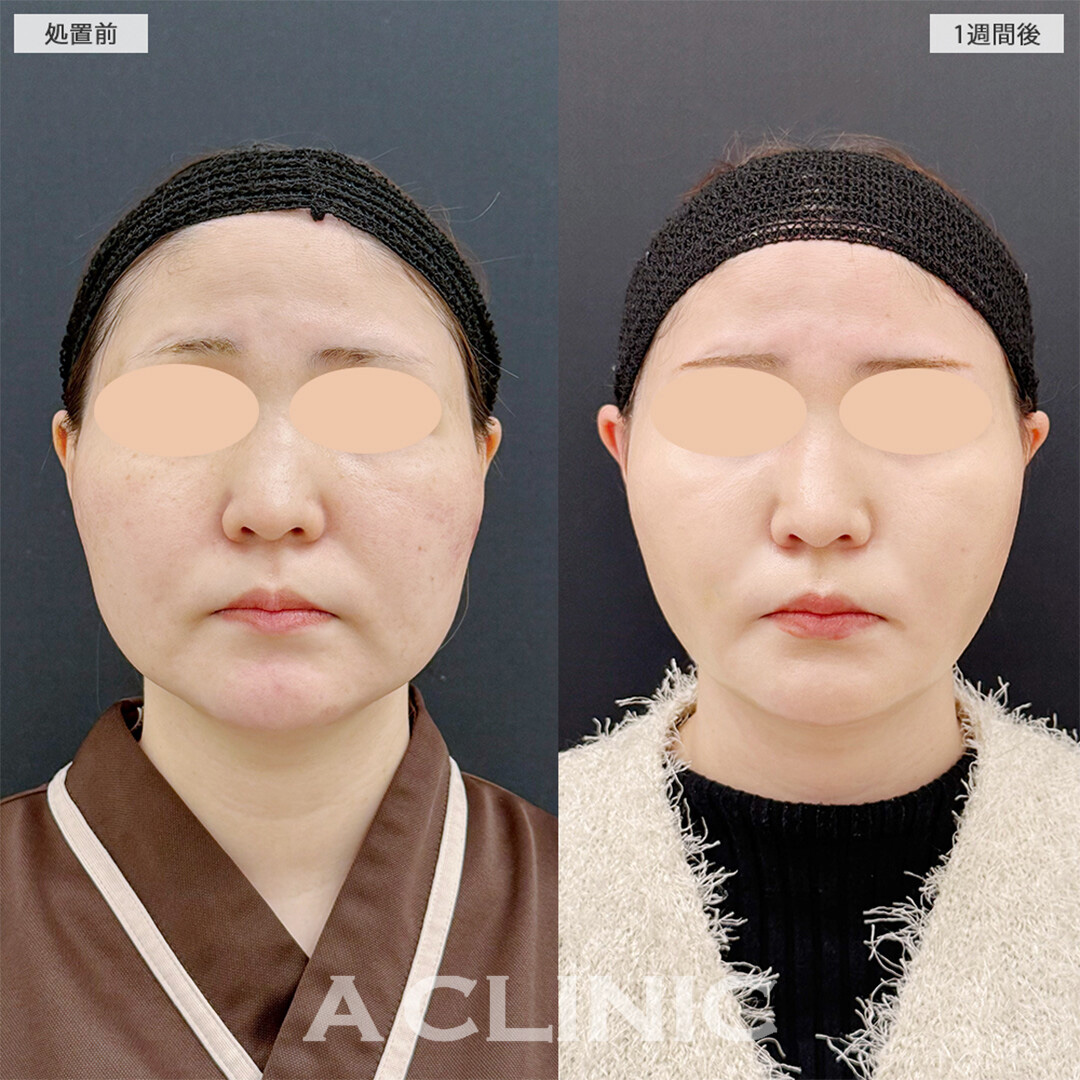1day小顔脂肪吸引で周りから褒められる輪郭に！こちら処置前と1週間後の症例です(20代女性)