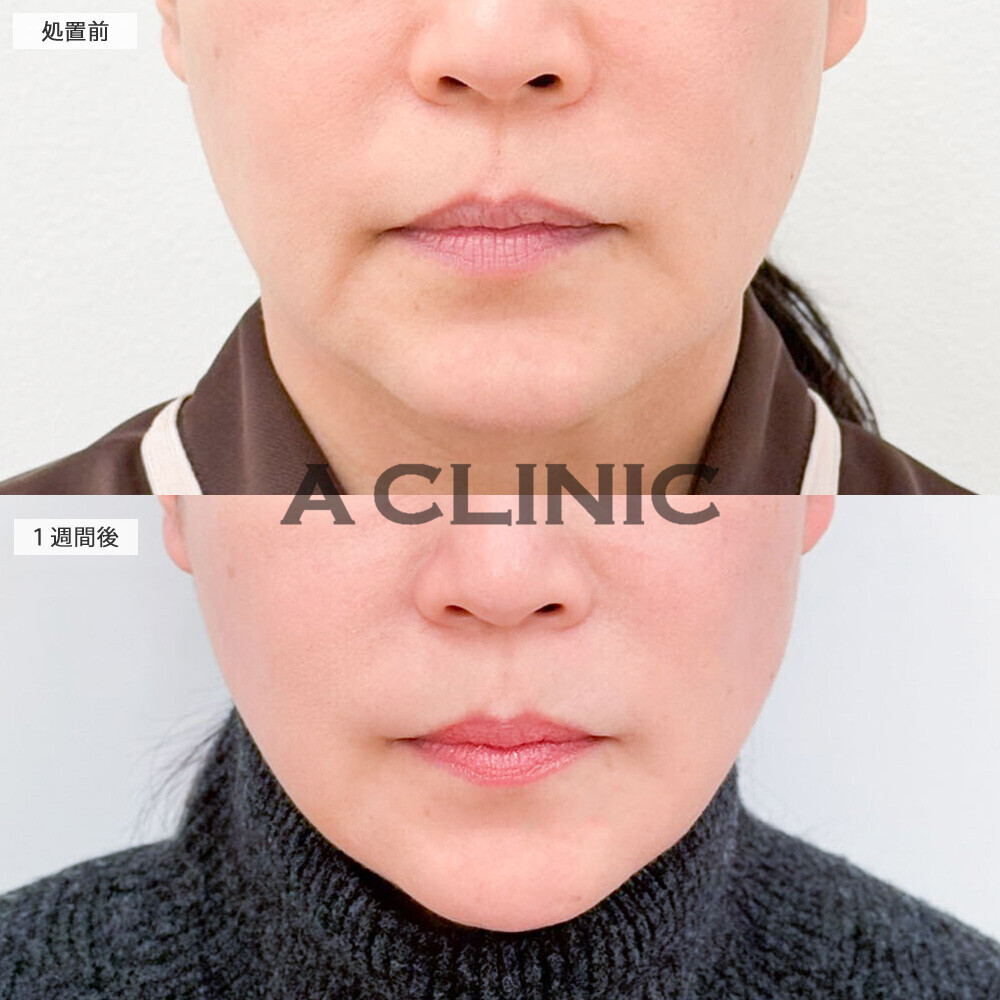 1day小顔脂肪吸引で10歳若返り！処置前から2ヶ月後の症例です(50代女性)
