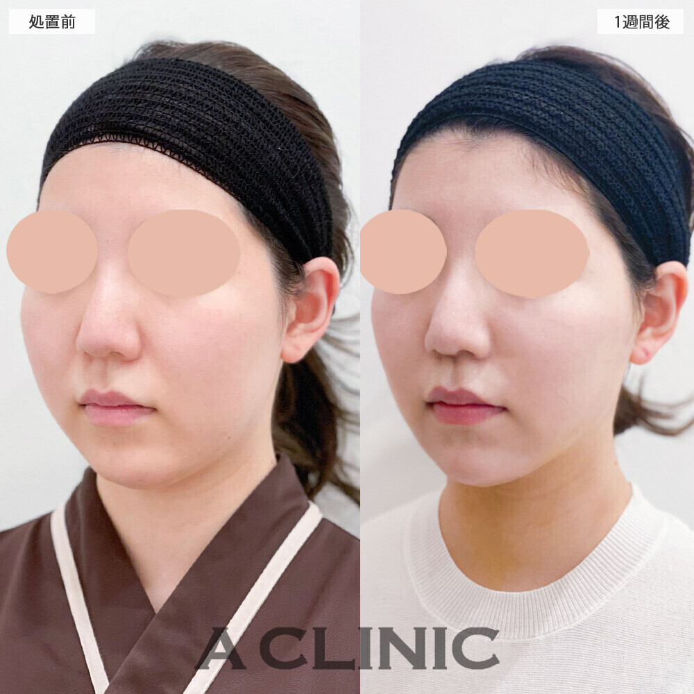 1day小顔脂肪吸引で丸顔解消！こちら処置前と1週間後の症例です(20代女性)