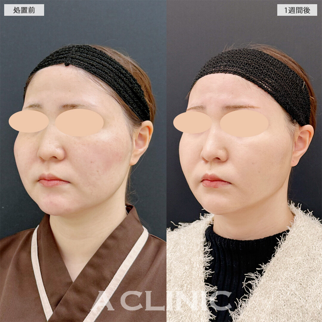 1day小顔脂肪吸引で周りから褒められる輪郭に！こちら処置前と1週間後の症例です(20代女性)