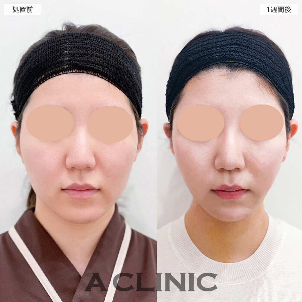 1day小顔脂肪吸引で丸顔解消！こちら処置前と1週間後の症例です(20代女性)