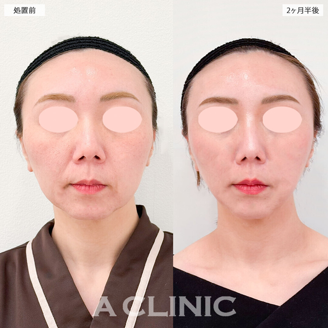 1day小顔脂肪吸引で一回りスッキリした理想のVフェイスに！処置前から2ヶ月半後の症例です(30代女性)