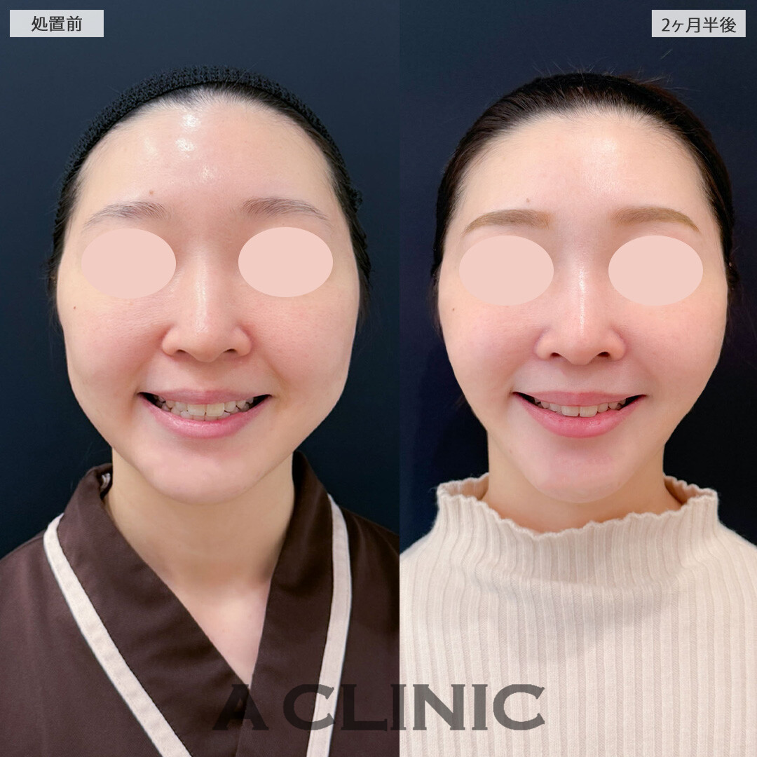 1day小顔脂肪吸引とナゾラビアルファット除去術とバッカルファット除去術で輪郭の脂肪がスッキリしました！こちら処置前と2ヶ月半後の症例です(20代女性)