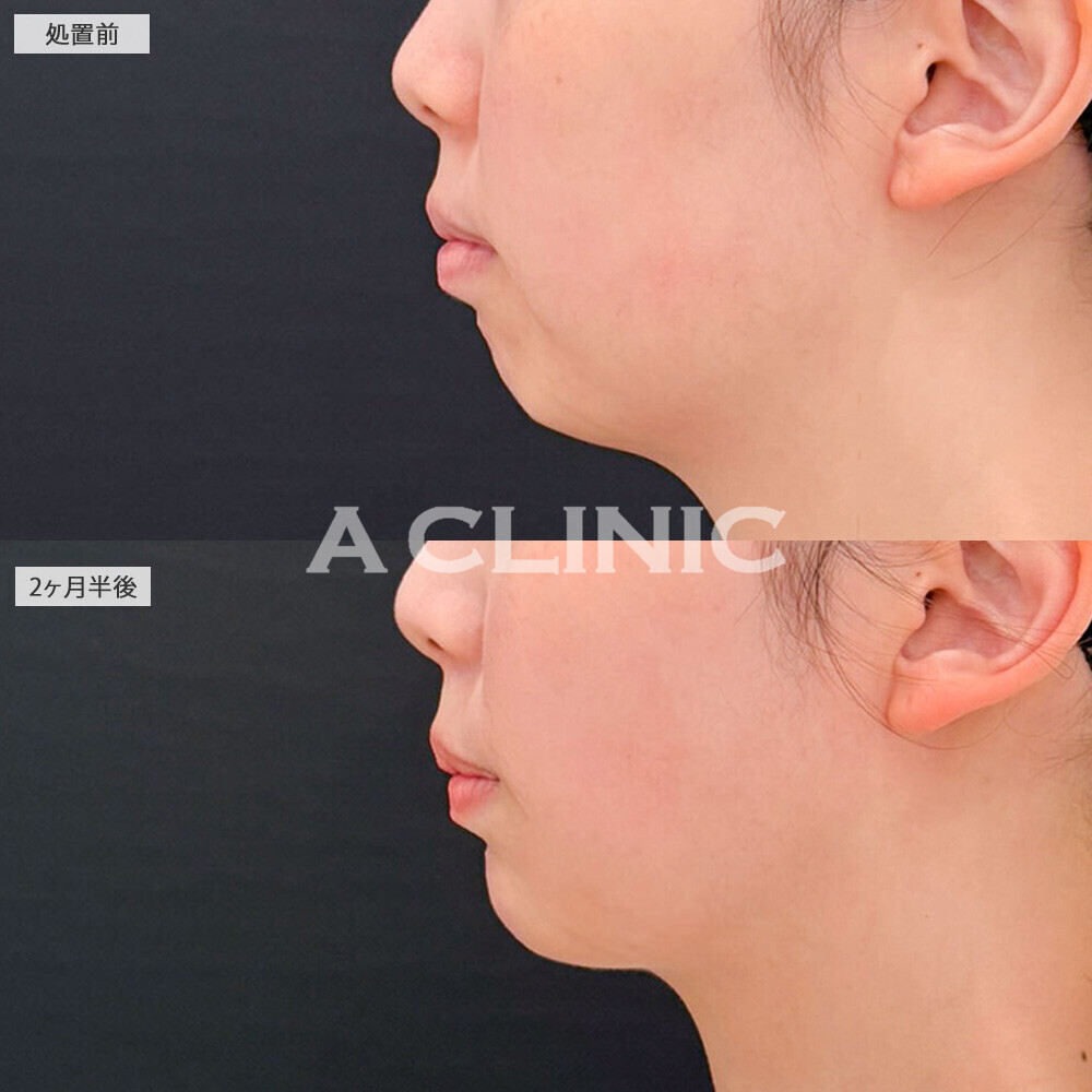 1day小顔脂肪吸引と複合施術でどこから見てもひと回り小顔にアップデート！こちら処置前と2ヶ月半後の症例です(20代女性)