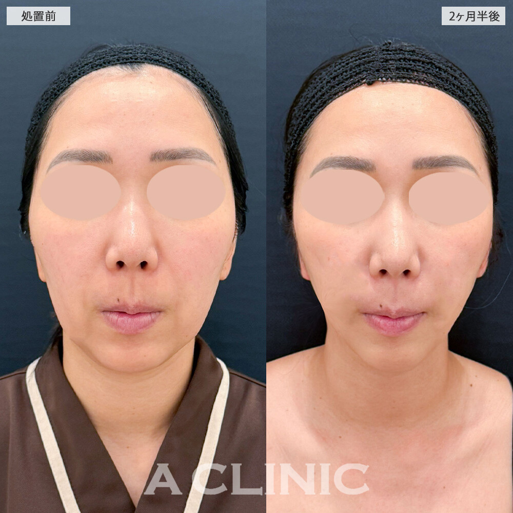 1day小顔脂肪吸引とナゾラビアルファット除去術で見違える程輪郭が変化しました！こちら処置前から2ヶ月半後の症例です(30代女性)