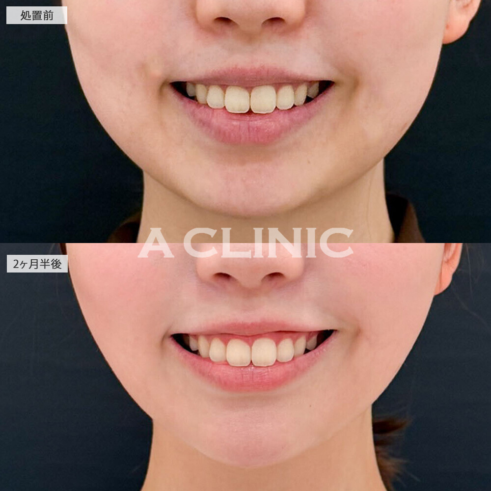 1day小顔脂肪吸引と複合施術でどこから見てもひと回り小顔にアップデート！こちら処置前と2ヶ月半後の症例です(20代女性)