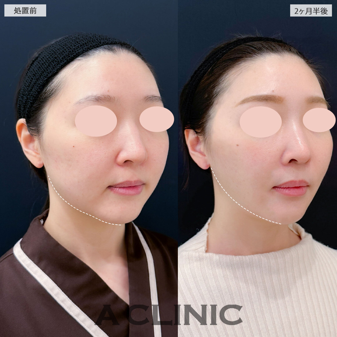 1day小顔脂肪吸引とナゾラビアルファット除去術とバッカルファット除去術で輪郭の脂肪がスッキリしました！こちら処置前と2ヶ月半後の症例です(20代女性)